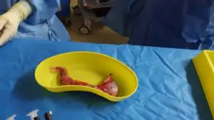 Gastric Sleeve Surgery – how much stomach is removed? Gastric Sleeve Surgery – how much stomach is removed?