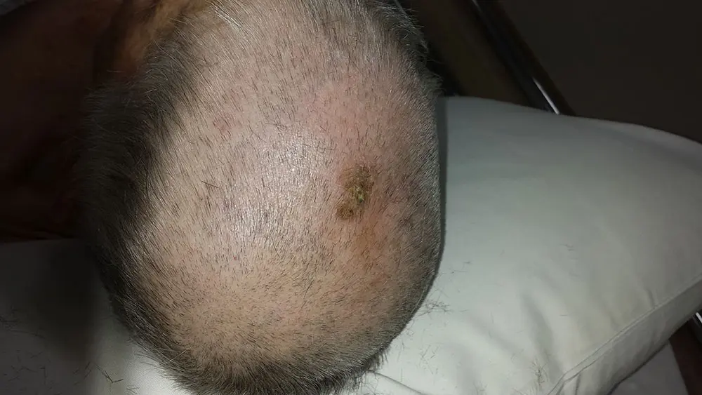 Scalp reconstruction – 30th pinwheel flap Scalp reconstruction – 30th pinwheel flap