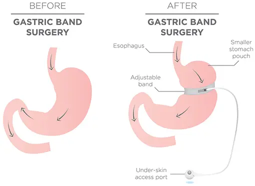 What to do about the failed lap band? What to do about the failed lap band?