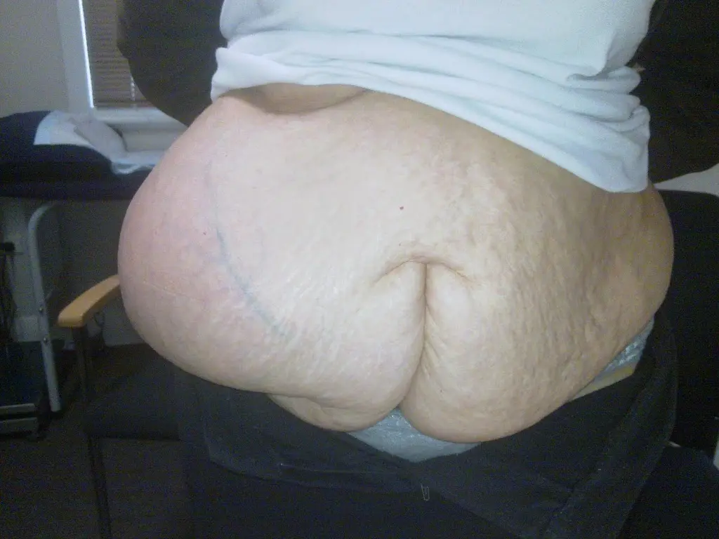 Obese patients have more surgical complications Obese patients have more surgical complications