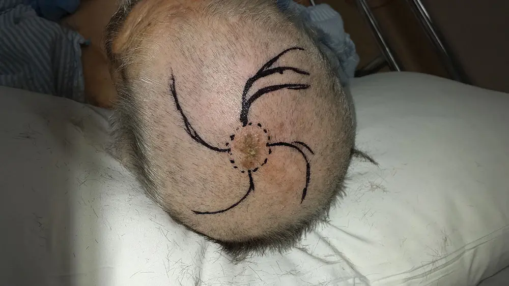 Scalp reconstruction