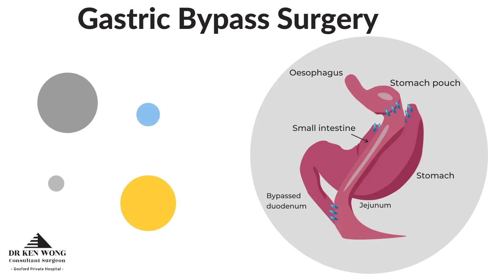 gastric bypass surgery diagram