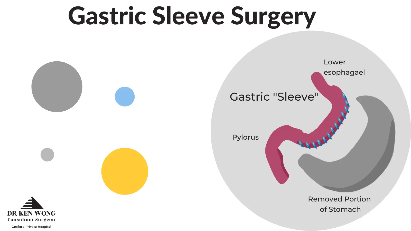 gastric sleeve surgery