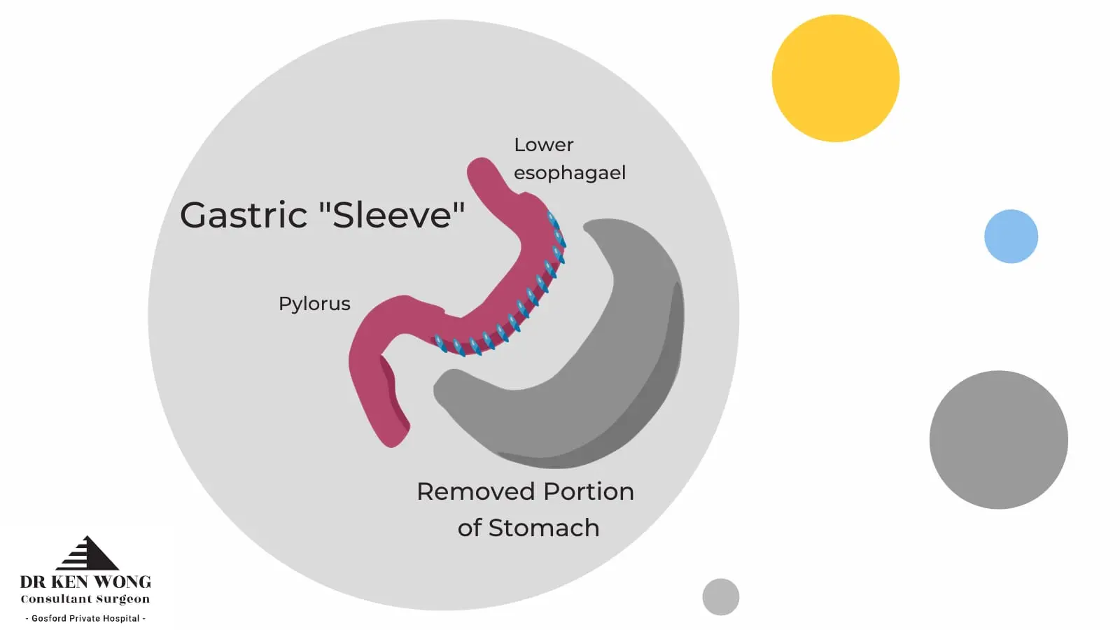 diagram showing what is involved in newcastle gastric sleeve
