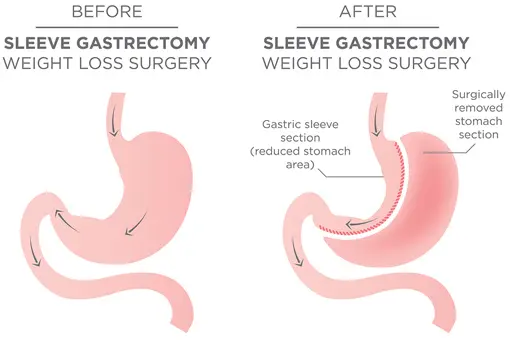 Gastric Sleeve Surgery