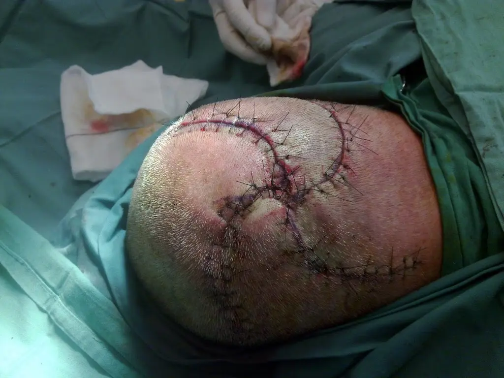 Skin Cancer Surgery 2