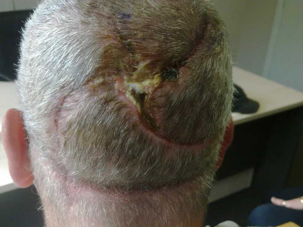 Skin Cancer Surgery 3