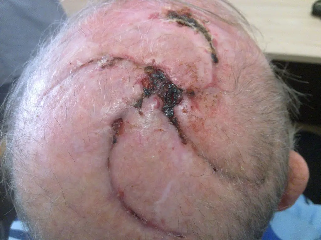 Skin Cancer Surgery 