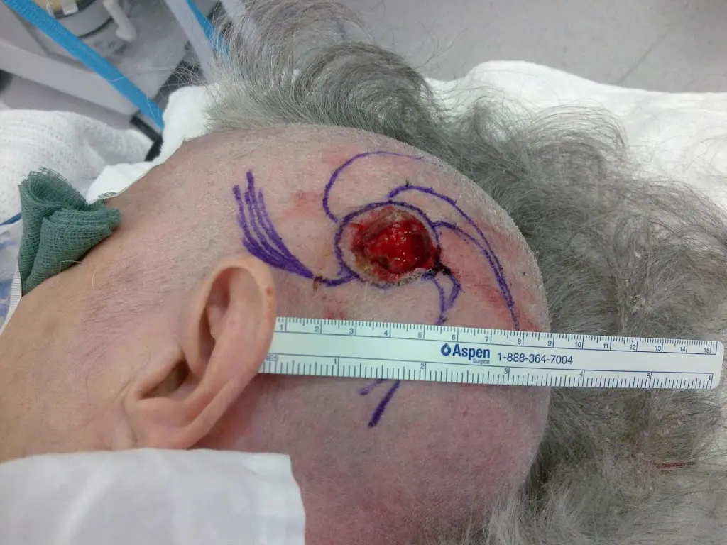 Scalp Cancer Surgery 1