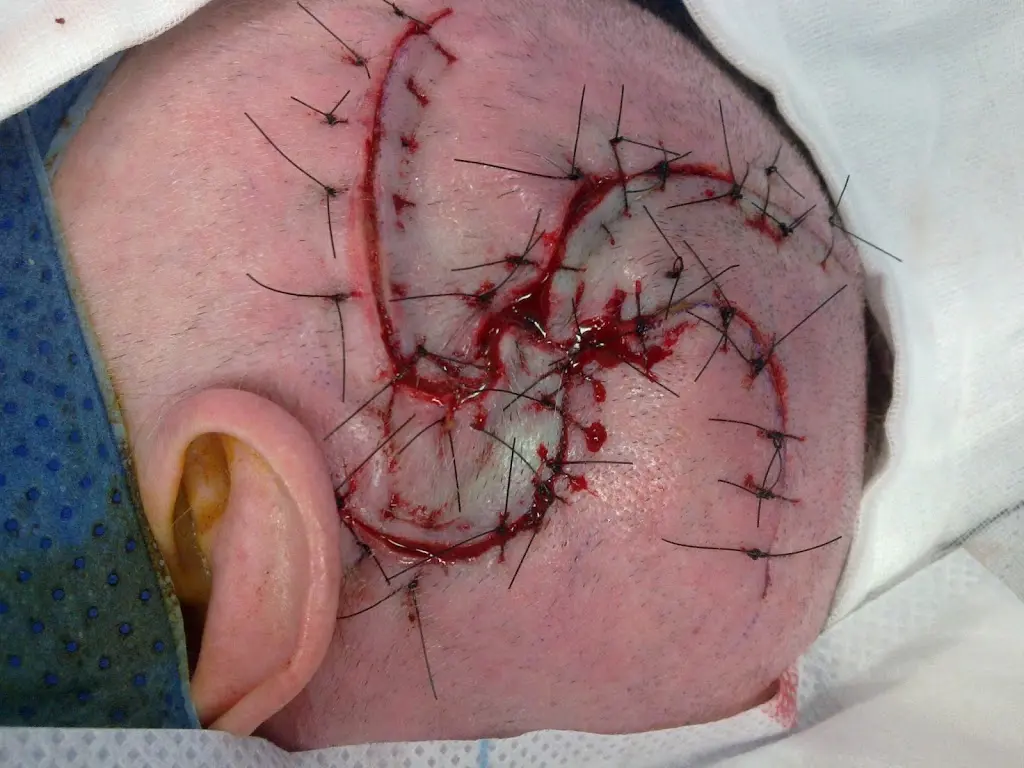 Scalp Cancer Surgery 2