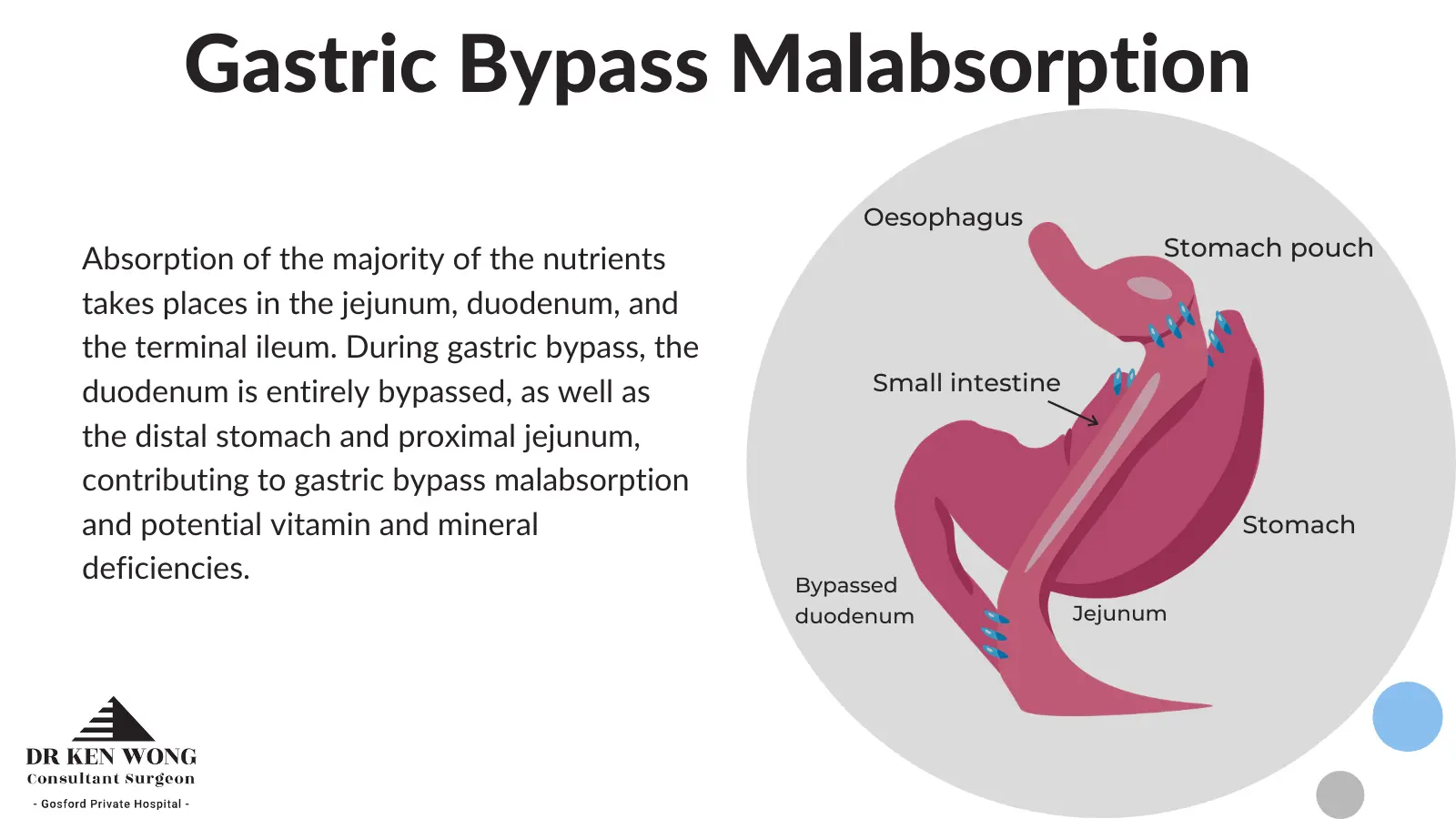 gastric bypass malabsorption