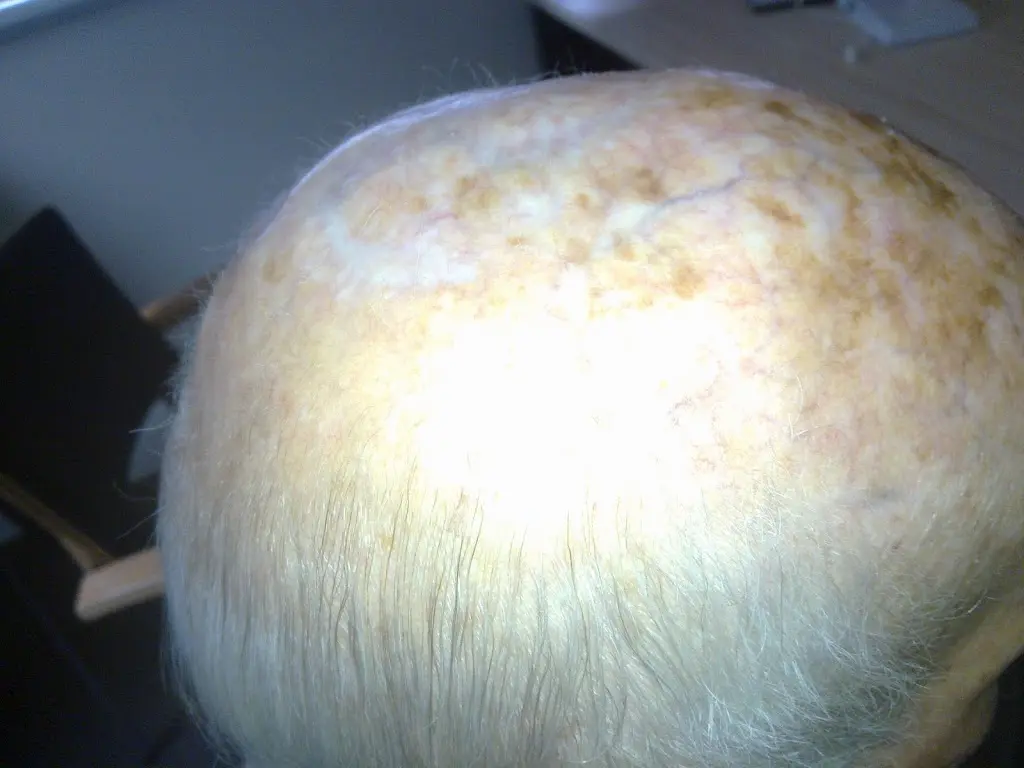 Pinwheel Flaps for Cancers on Scalp