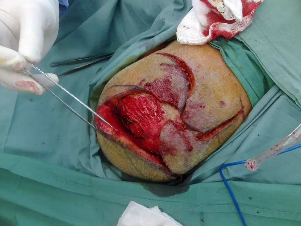 Pinwheel flaps and scalp skin cancer – part two Pinwheel flaps and scalp skin cancer – part two