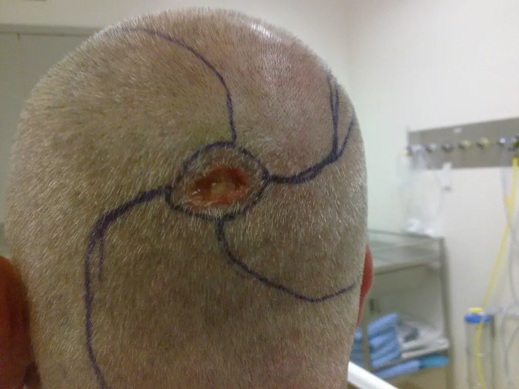 Pinwheel flaps and scalp skin cancer – part one