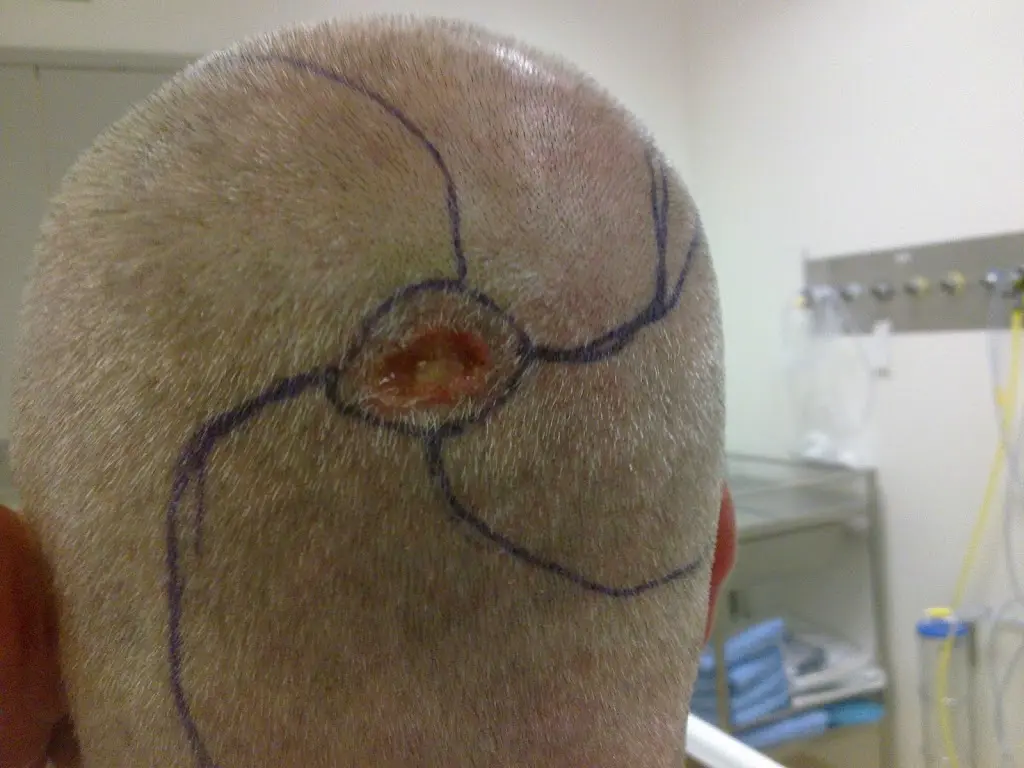 Pinwheel flaps and scalp skin cancer – part one Pinwheel flaps and scalp skin cancer – part one
