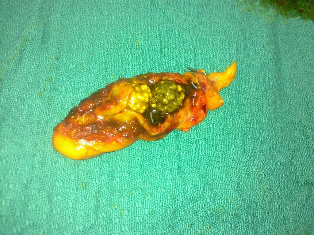 Gallstones and gallbladder removed by keyhole surgery