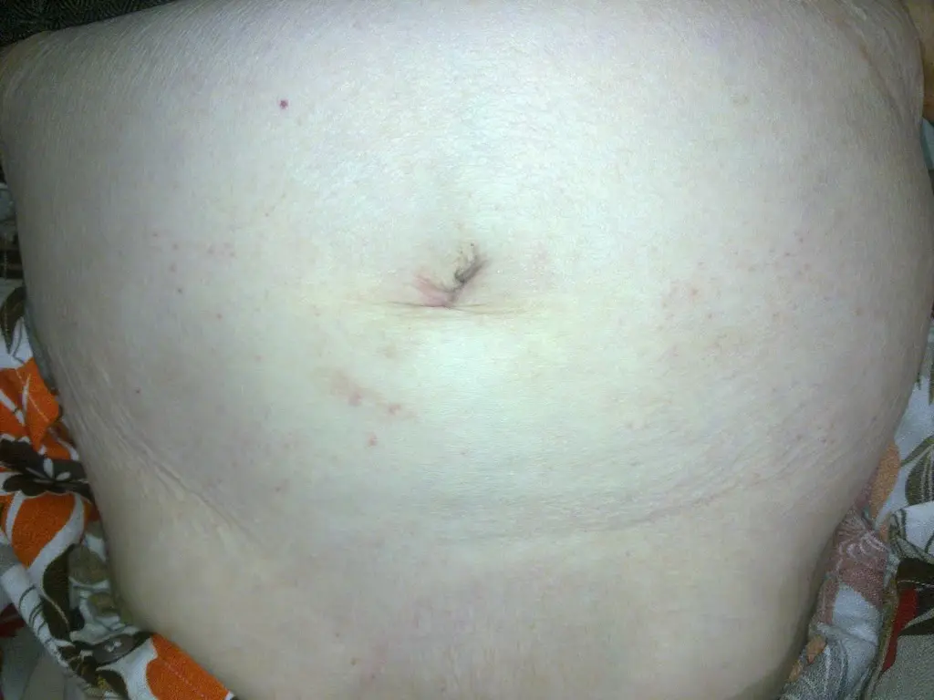 4 weeks after scarless gallbladder surgery