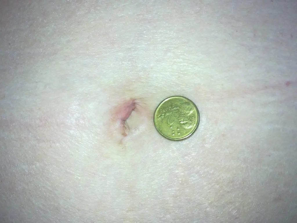 Picture of scar after single keyhole (scarless) surgery