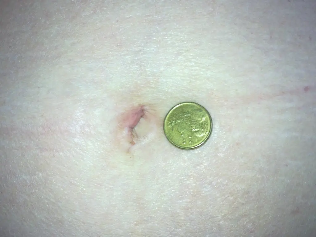 Picture of scar after single keyhole (scarless) surgery Picture of scar after single keyhole (scarless) surgery