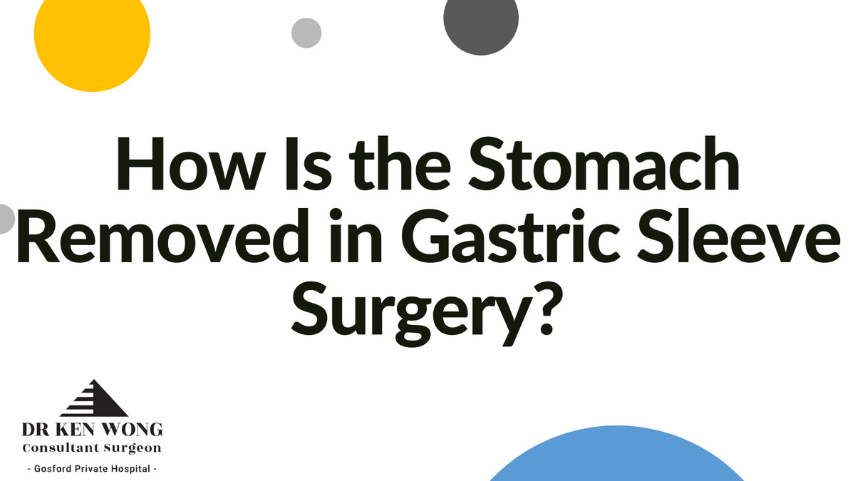 How Is the Stomach Removed in Gastric Sleeve Surgery?